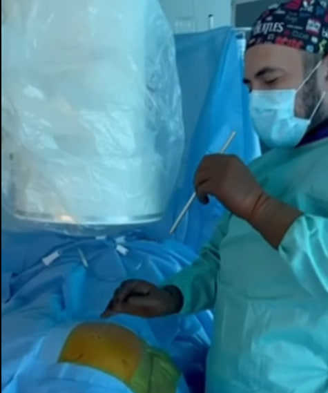 У Кіровоградському онкологічному центрі вперше в Україні виконали ендоскопічне видалення пухлини кістки.