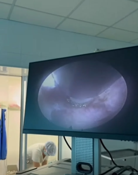 У Кіровоградському онкологічному центрі вперше в Україні виконали ендоскопічне видалення пухлини кістки.