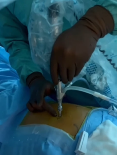 У Кіровоградському онкологічному центрі вперше в Україні виконали ендоскопічне видалення пухлини кістки.