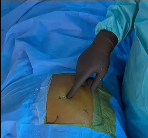 У Кіровоградському онкологічному центрі вперше в Україні виконали ендоскопічне видалення пухлини кістки.